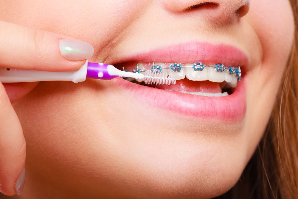 6 mẹo cấp cứu niềng răng tại nhà hoặc đi du lịch