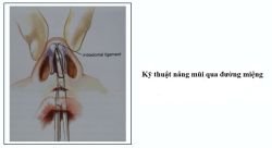 Kỹ thuật nâng mũi qua đường miệng, bạn đã biết?