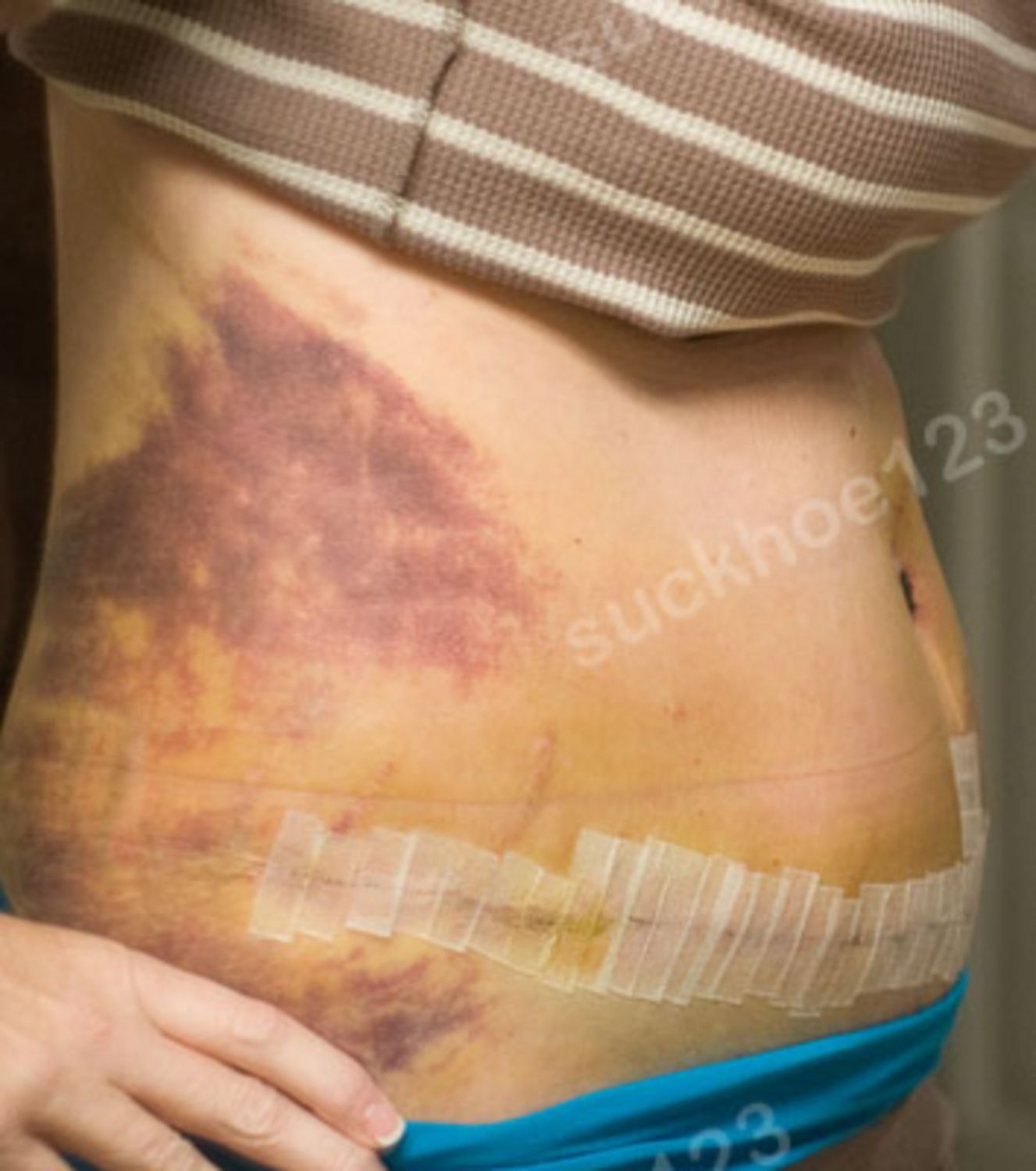 Bầm tím sau tạo hình thành bụng