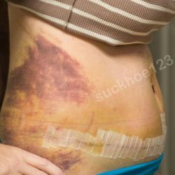 Bầm tím sau tạo hình thành bụng