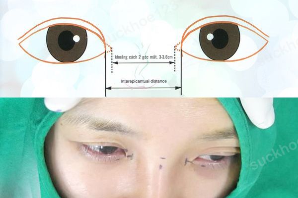 Giải mã xu hướng phẫu thuật mở rộng góc mắt