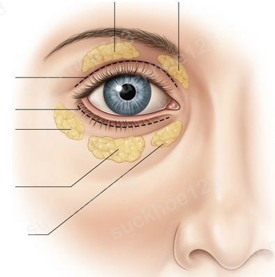Cấy mỡ mí mắt: giải pháp cho đôi mắt trũng sâu
