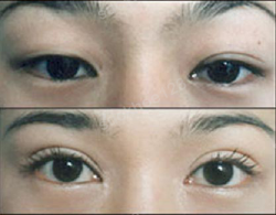 Sụp mí và các biện pháp khắc phục