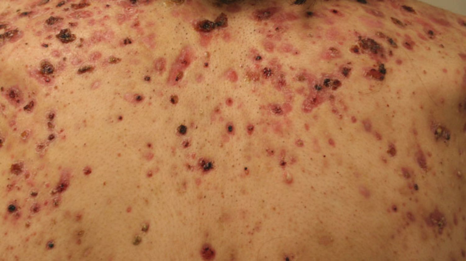 Tác động của steroid (corticoid) lên da