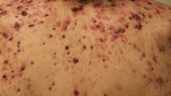 Tác động của steroid (corticoid) lên da