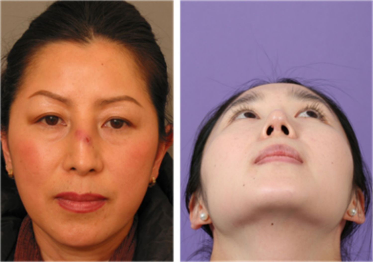 Tổng hợp những biến chứng có thể xảy ra sau nâng mũi