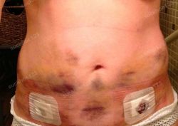 Bầm tím da sau hút mỡ có đáng lo ngại không?