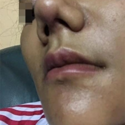 Sửa mũi 2 lần bị viêm và sẹo co rút thì làm sao?