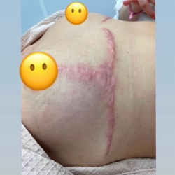 Treo sa trễ 1 năm vẫn còn sẹo