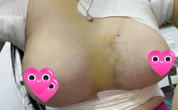 Làm ngực được 4 ngày khe xa quá thì làm sao?