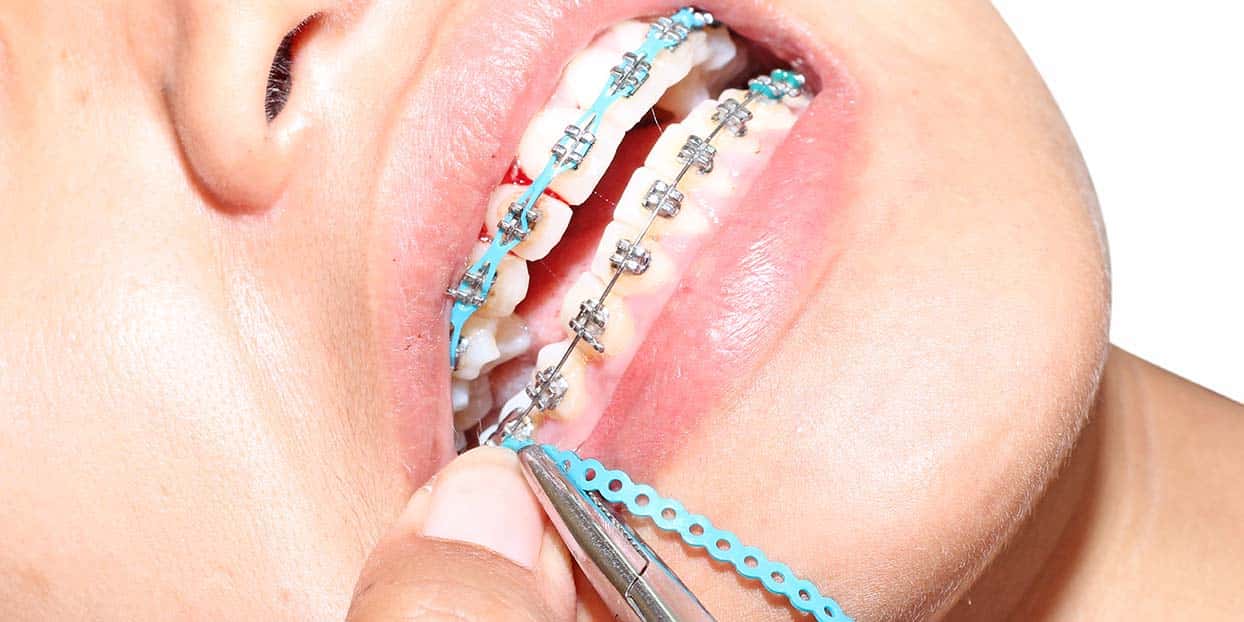 Tìm hiểu các bước của quá trình niềng răng