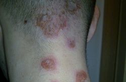 Cách điều trị mới dành cho bệnh chốc lở