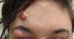 Cách trị mụn bọc