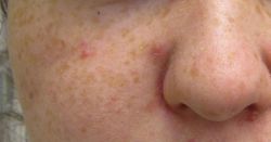 Các phương pháp trị mụn cho từng vùng trên cơ thể