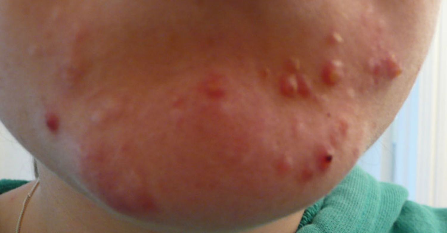 Cách trị mụn trứng cá vùng cằm