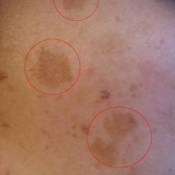 Một số thông tin về nám da