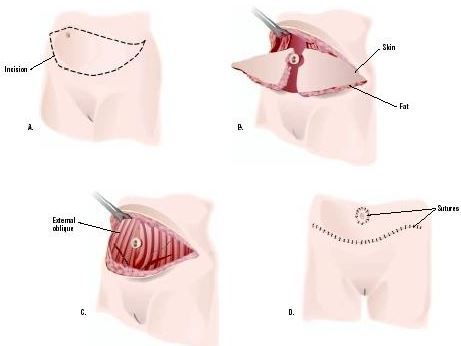 Căng da bụng dưới (panniculectomy)