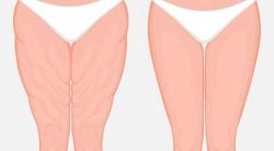 Tìm hiểu về căng da đùi