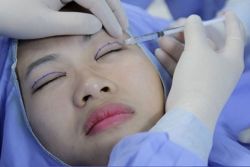 Cắt mí giá bao nhiêu tiền? Đăng ký trợ giá cắt mí mắt tại các bệnh viện, thẩm mỹ viện uy tín