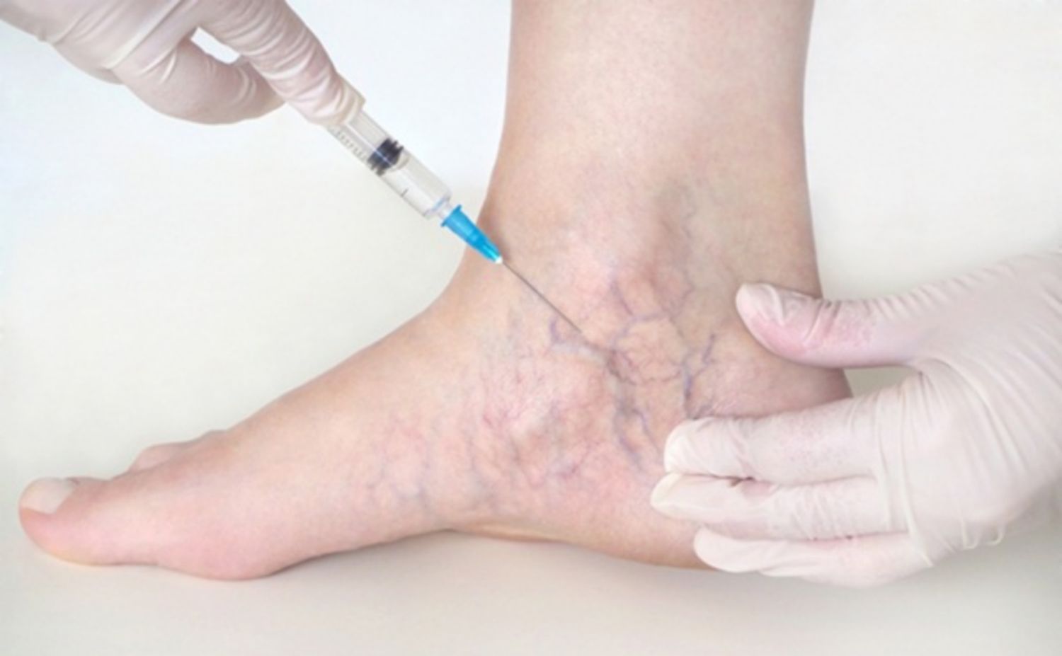Phương pháp tiêm xơ tĩnh mạch có hiệu quả như thế nào?