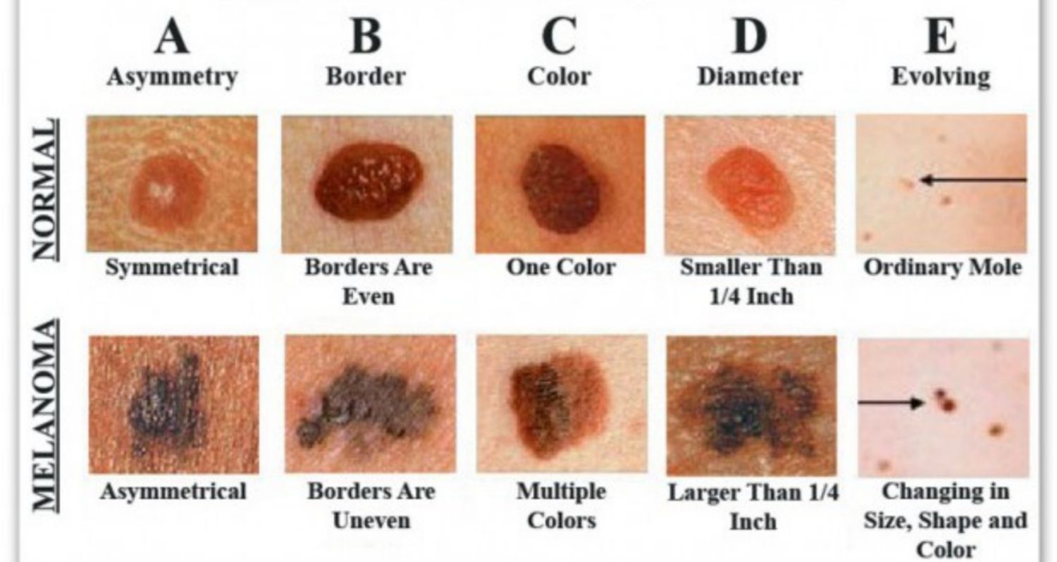 Cách nhận biết ung thư da