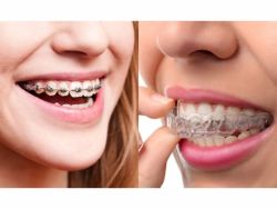 Đối tượng của niềng răng kim loại và niềng răng trong suốt invisalign