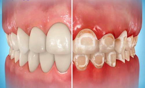 Niềng răng có gây ra các đốm trắng trên răng không?