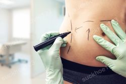 Kỹ thuật tạo hình thành bụng không đặt ống dẫn lưu là gì?