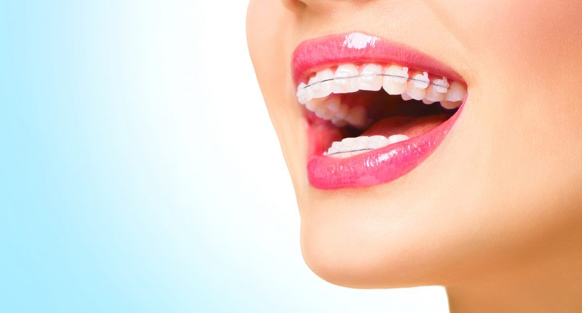 Cách duy trì hàm răng hoàn hảo sau khi tháo niềng