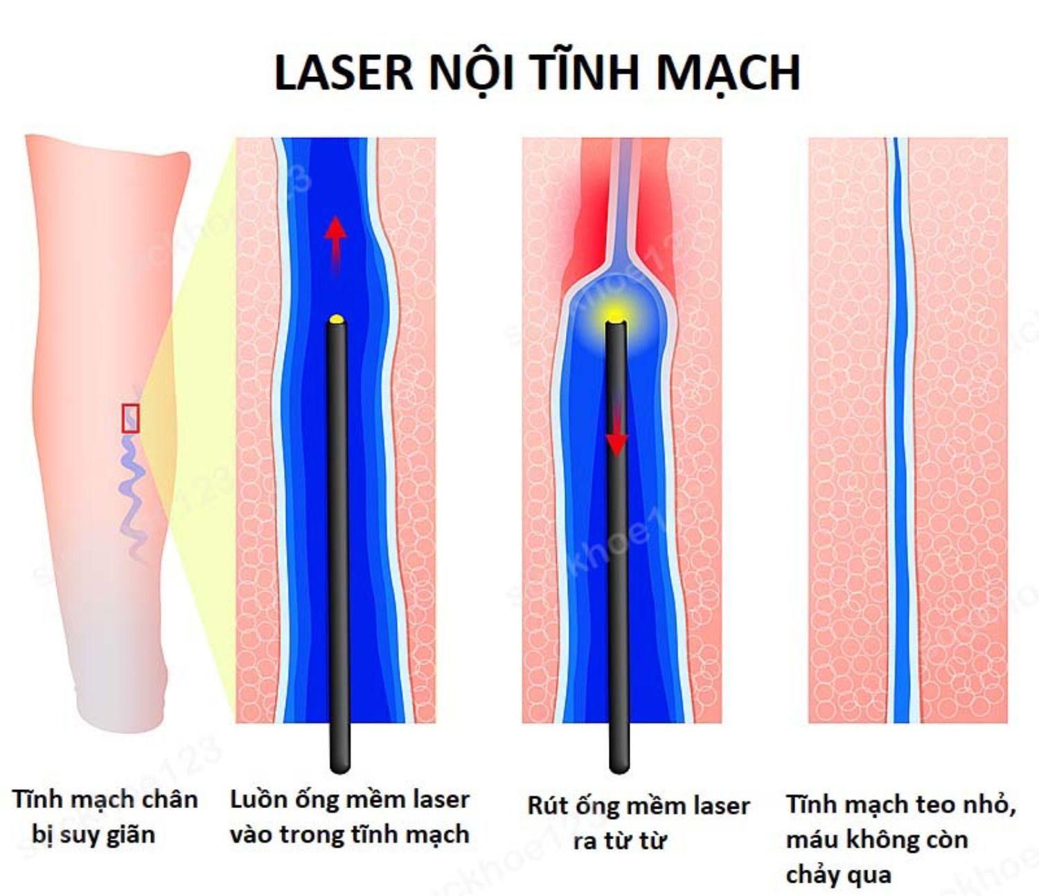Laser nội tĩnh mạch EVLT