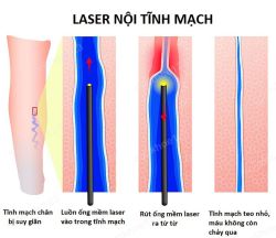 Laser nội tĩnh mạch EVLT