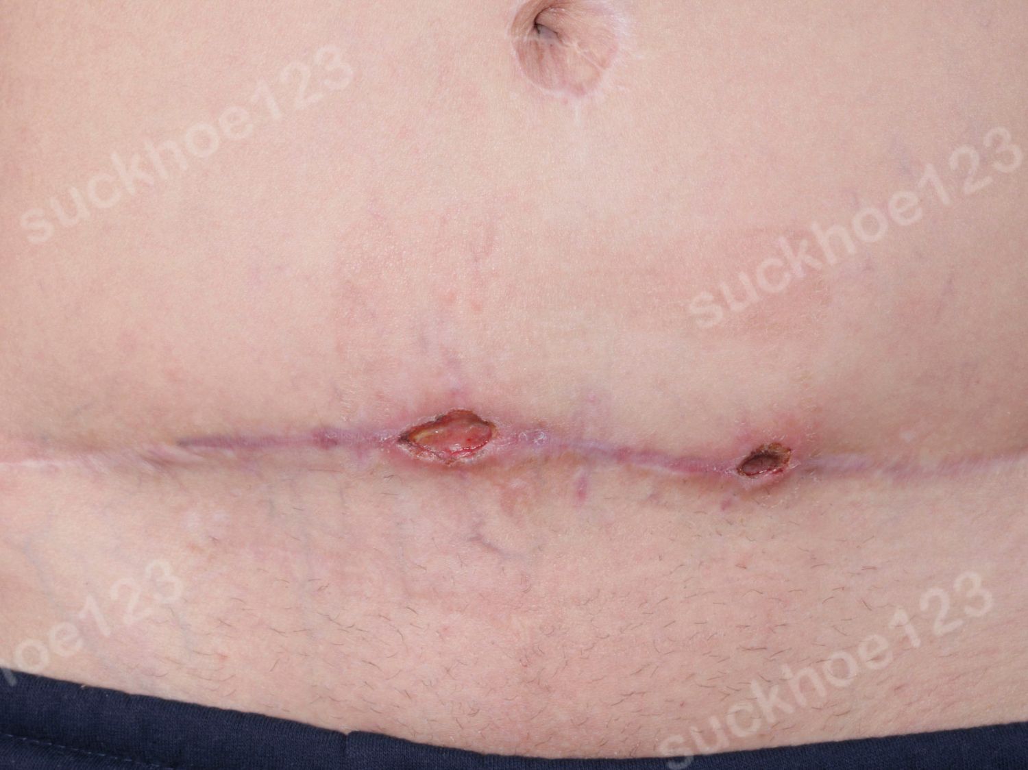 Hoại tử sau tạo hình thành bụng