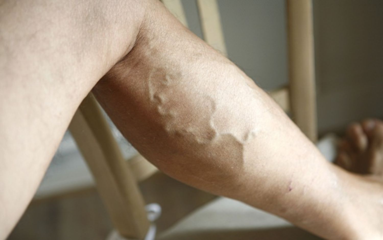 7 điều cần biết về bệnh suy giãn tĩnh mạch