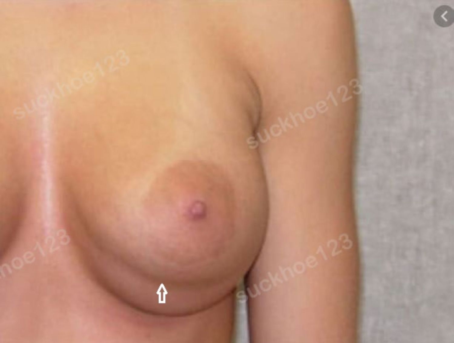Biến chứng gò ngực kép sau phẫu thuật nâng ngực