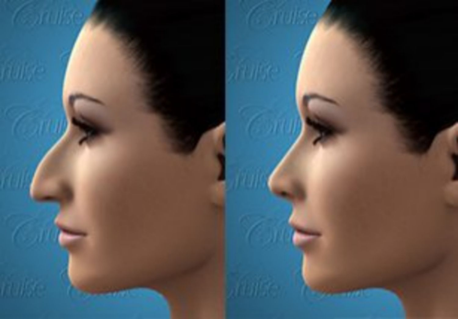 Phẫu thuật chỉnh hình mũi dài