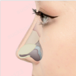 Phẫu thuật tạo hình đầu mũi