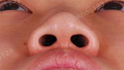 Các biến chứng có thể gặp phải sau phẫu thuật chỉnh hình, thu gọn cánh mũi