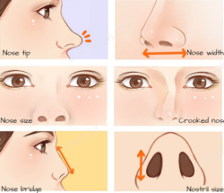 Các biến chứng có thể gặp phải sau nâng mũi bằng sụn tự thân