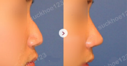 Các biến chứng có thể gặp phải sau chỉnh sửa mũi gồ