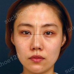 Các biến chứng có thể gặp phải sau chỉnh sửa mũi lệch, xoắn