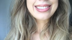 Cười lệch, cười không tự nhiên sau tiêm botox thon gọn hàm