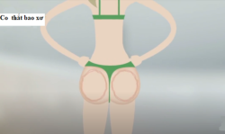 Co thắt bao xơ sau đặt túi độn mông: nguyên nhân và cách xử lý