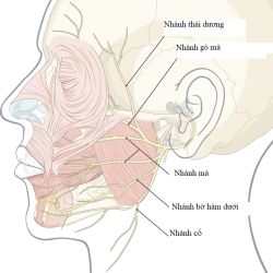 Biến chứng liệt nhánh trán dây thần kinh mặt sau phẫu thuật thẩm mỹ vùng mặt