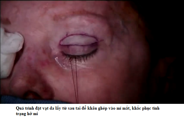 hở mi ghép da