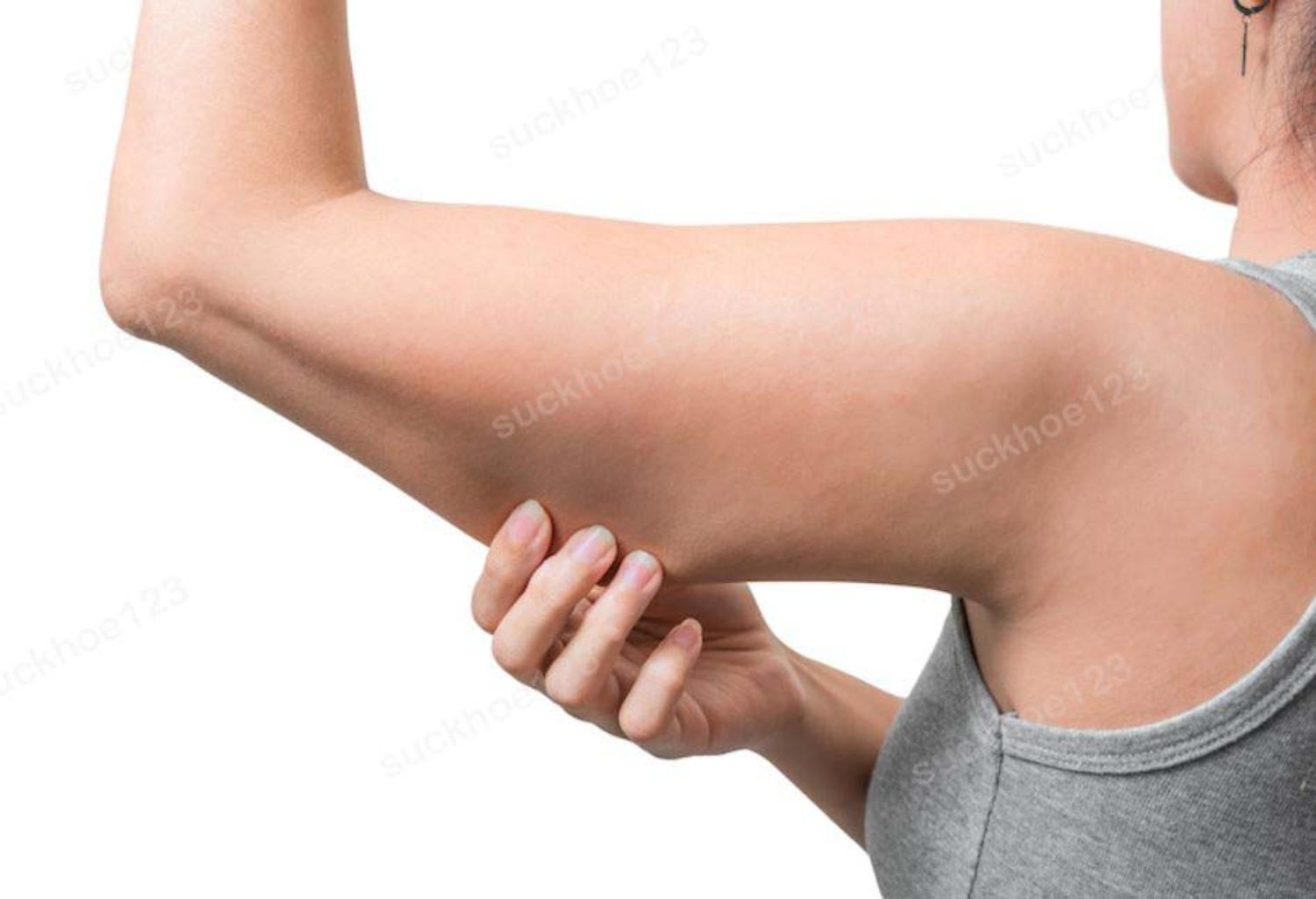 Hút mỡ cánh tay (bắp tay)