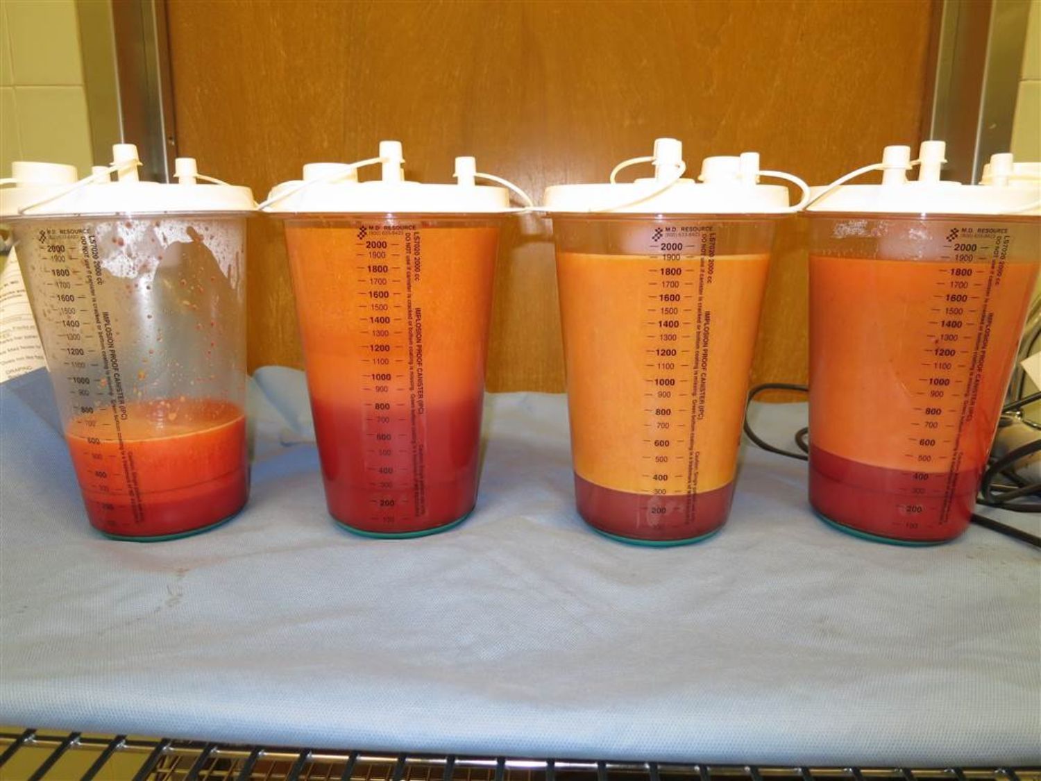 Hút mỡ thể tích lớn