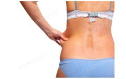Hút mỡ ụ hông (vùng lườn, eo)