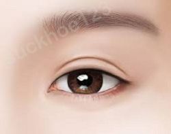 Cắt mí toàn phần (đường mổ dài)