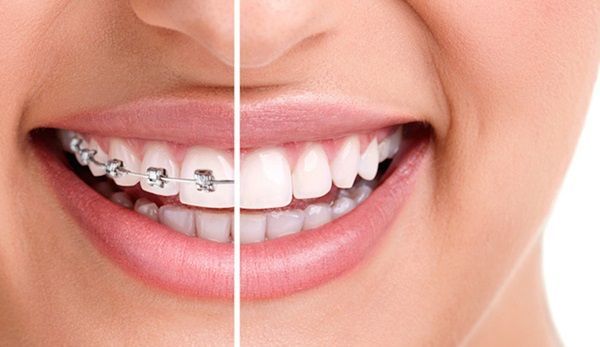 Niềng răng Invisalign khác gì với niềng răng truyền thống?