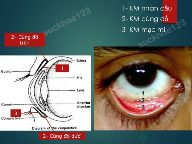 Sa kết mạc sau phẫu thuật sụp mi